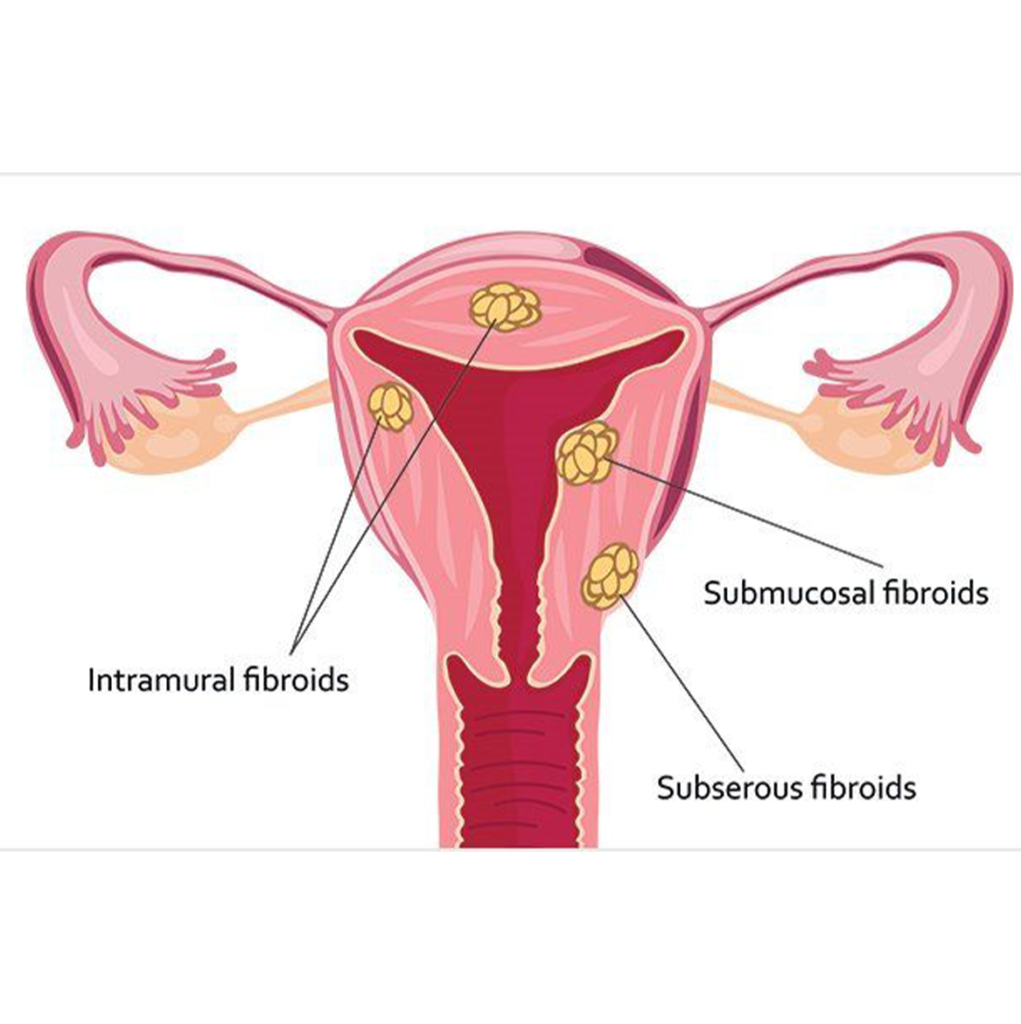 Fibroid