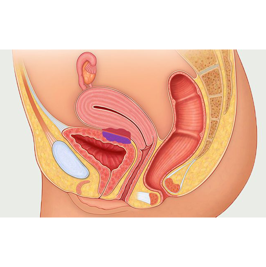 Endometriosis