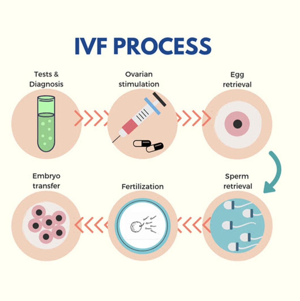 In Vitro Fertilization (IVF)