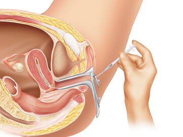 Intrauterine Insemination ( IUI) ( Husband / Donor)